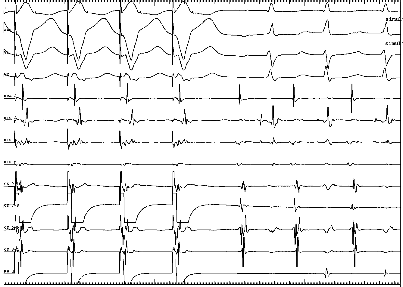 simult av pacing return signal a.JPG